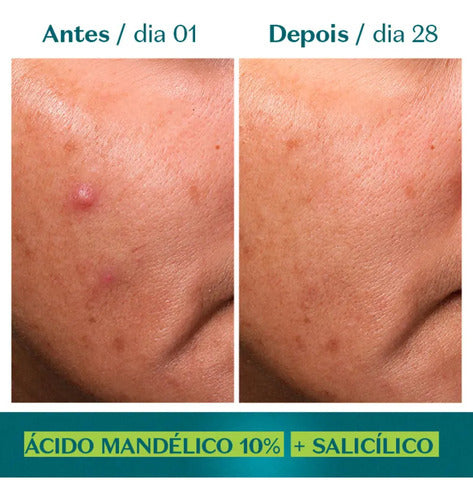 SÉRUM DE ALTA POTÊNCIA ÁCIDO MANDÉLICO 10% + SALICÍLICO BOTIK 30ML